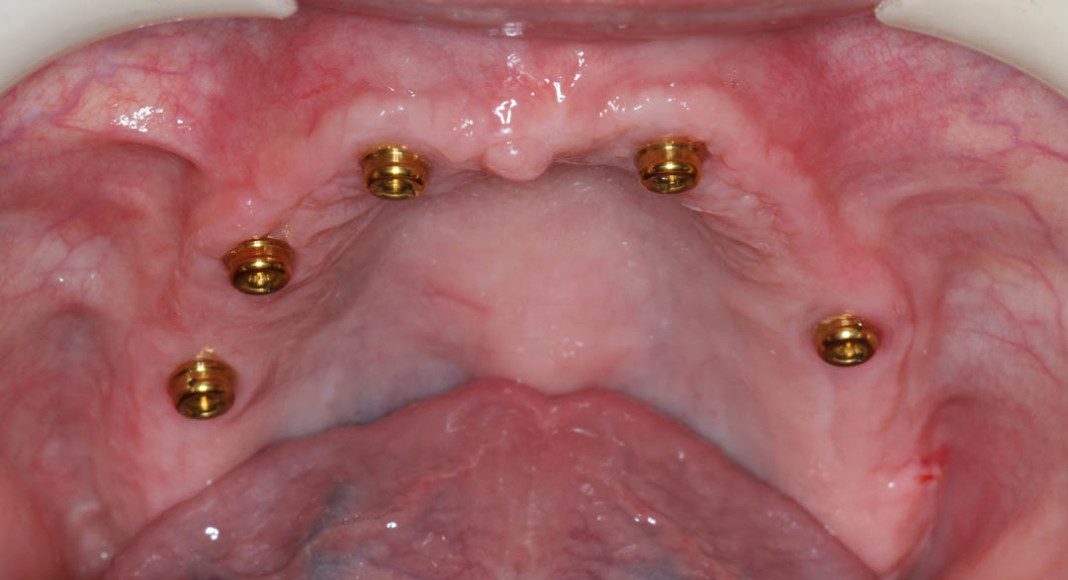 Upper And Lower Implant Overdentures Total Implants Male