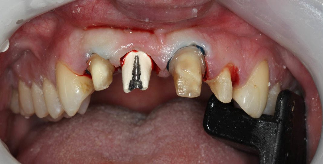 Front Implant Crown – Right Central Incisor implant with three other