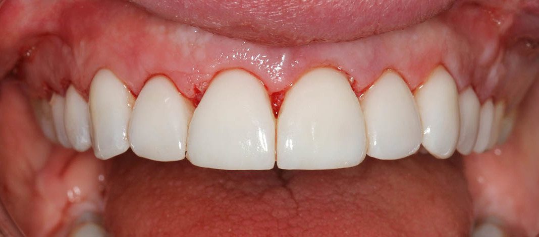 Cosmetic, A1 Veneers - Dental Implant Center