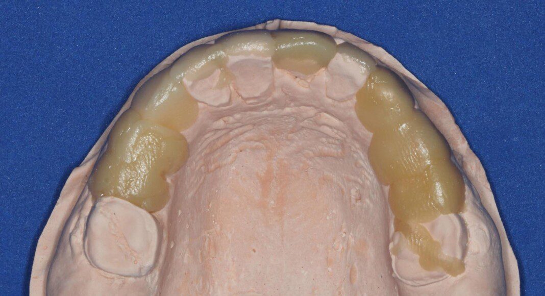 Full Mouth Porcelain Crowns - Amelogenesis Imprefecta (genetic Enamel 