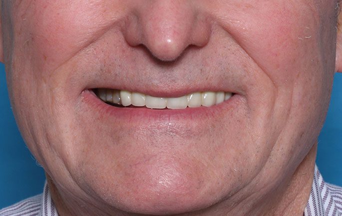 bridge teeth implant male smile face dental