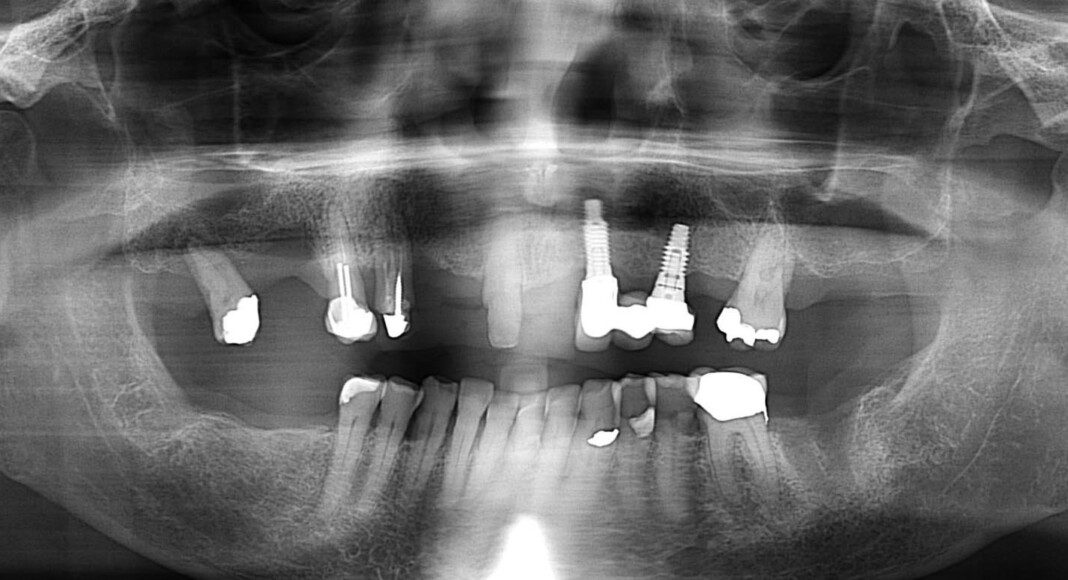 Pre-op panoramic image. Note: existing implants. Pre-op, frontal full-face smile.