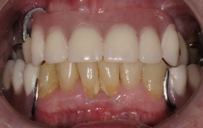 Upper and Lower Removable Partial Dentures without Implants
