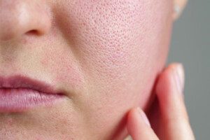 Close-up of a person's cheek with visible pores and slight redness, showing skin texture and a hand touching the face.