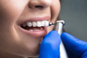 process of using stomatological brush as a stage of professional dental cleaning procedure