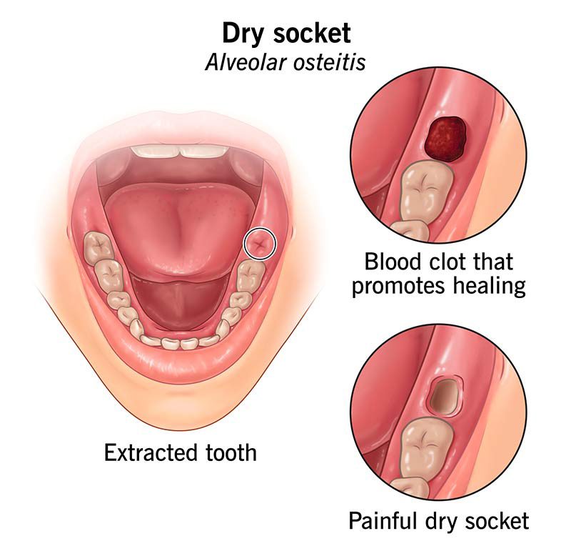 Dry Socket: What It Is And How To Prevent It - Dental Implant Center