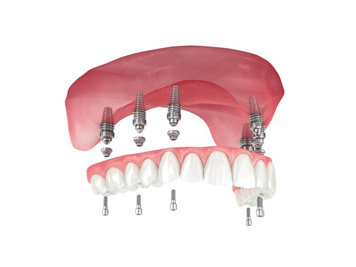 Permanent Dentures - Dental Implant Center