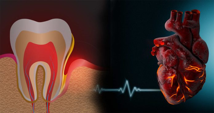 How Oral Bacteria Can Trigger Heart Disease