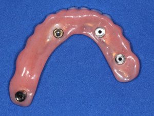 “Correct design of fixed implant bridges and dentures, convex, fits smoothly against gums, very cleansable””