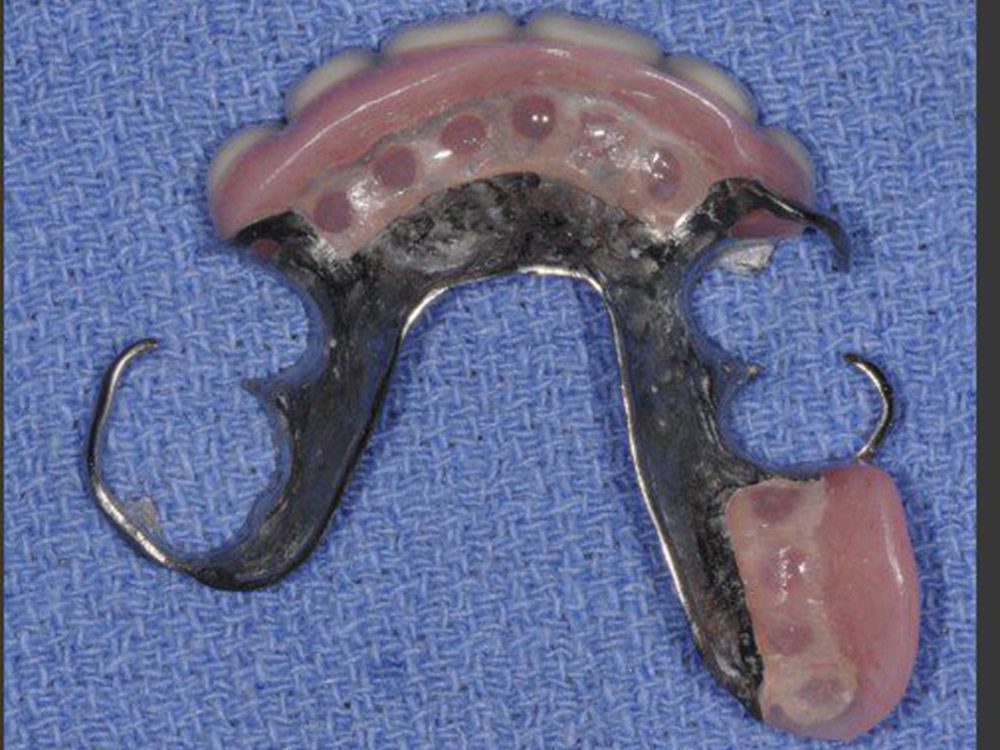 Partial Dentures For Front Teeth - Dental Implant Center