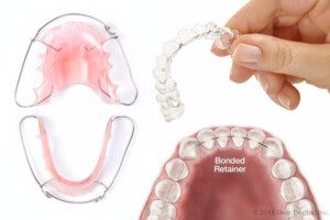 Image of dental appliances: two metal retainers, a clear aligner held by a hand, and a diagram showing a bonded retainer on teeth.