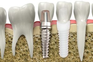 cross section illustration of dental implant in the jaw