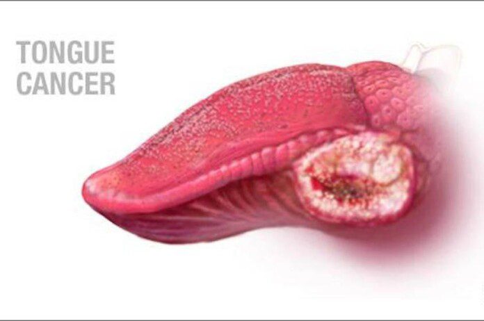 Tongue Cancer CoverCROPPED 696x462 