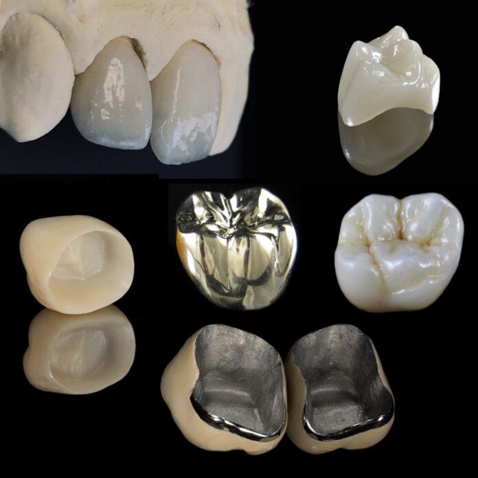 How Much Do Crowns Cost? - Dental Implant Center