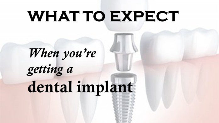 What To Expect When Getting Dental Implants