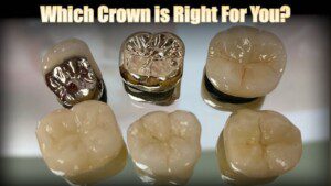 WHICH TYPE OF DENTAL CROWN IS BEST?