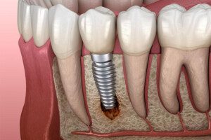 A cross-sectional illustration of a dental implant in the jaw, showing an inflamed area near the base of the implant.