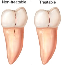 TREATABLE vs NON-TREATABLE CRACKS