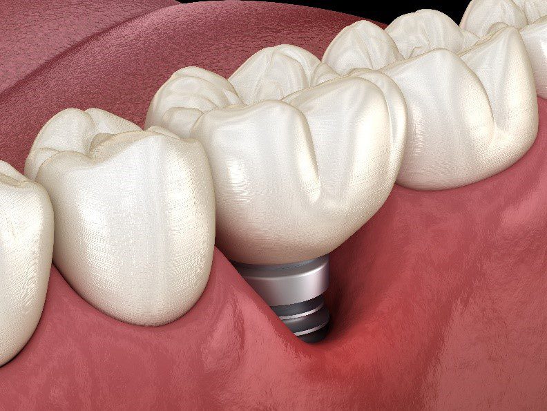 What is Peri-Implantitis? - Dental Implant Center