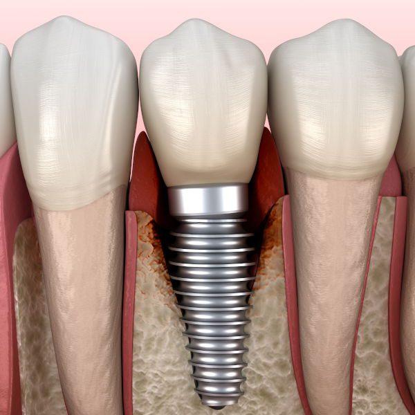 What is Peri-Implantitis? - Dental Implant Center